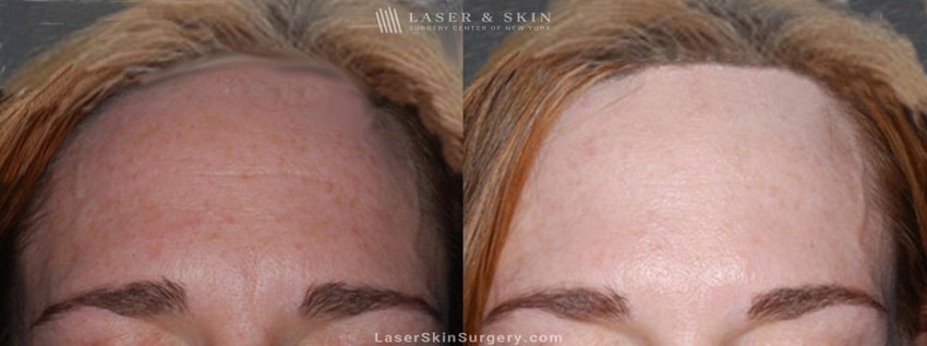 before and after image of a botox injection in a woman's forehead to reduce the appearance of wrinkles