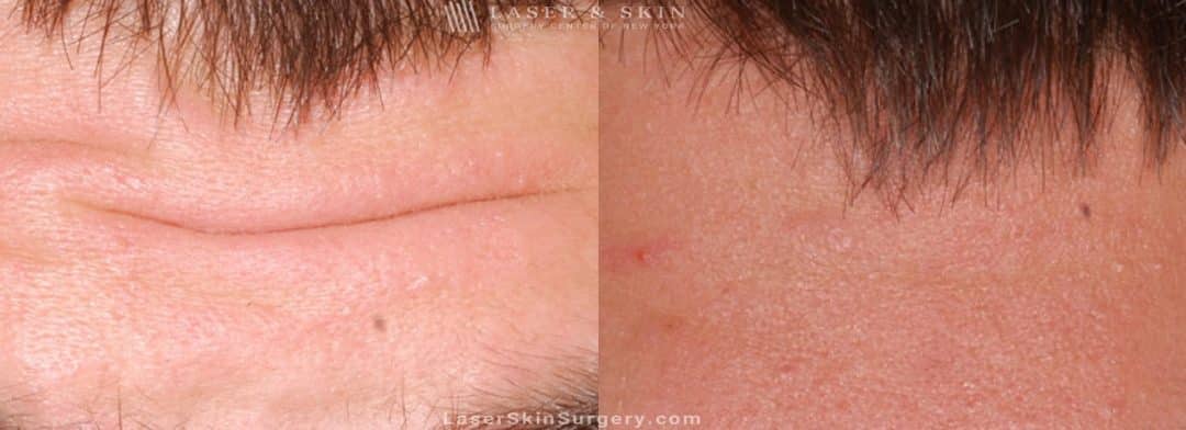 Before and after image of a botox injection procedure to a male patient's forehead to help relax his forehead wrinkles.