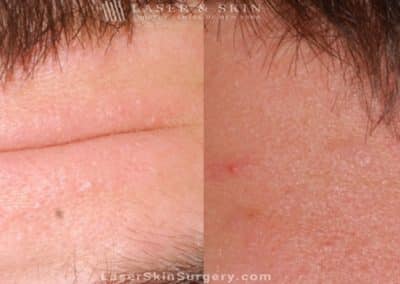 Botox Injections for Forehead Wrinkles