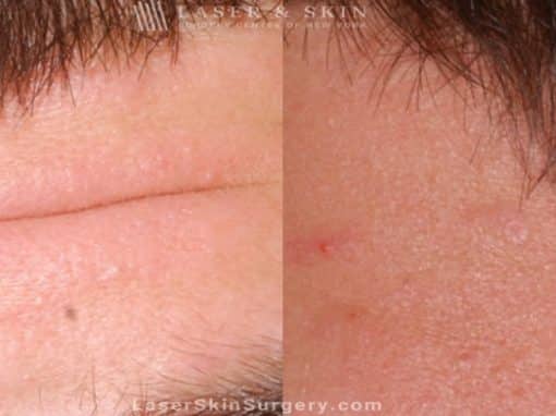 Botox Injections for Forehead Wrinkles