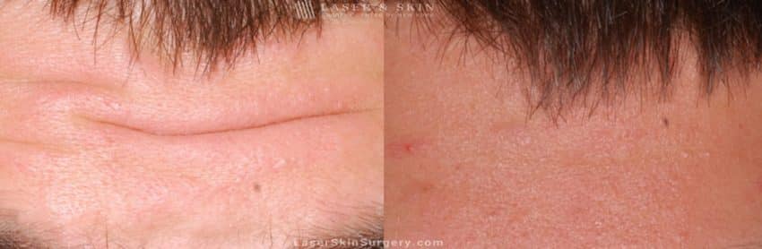 Before and after image of a botox injection procedure to a male patient's forehead to help relax his forehead wrinkles.