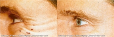 crows-feet-BA botox in new york