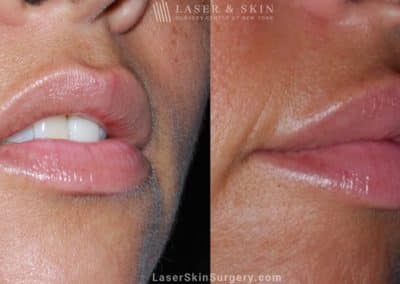 Filler Injections to add Volume to Lips