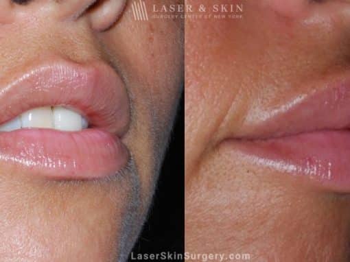 Filler Injections to add Volume to Lips