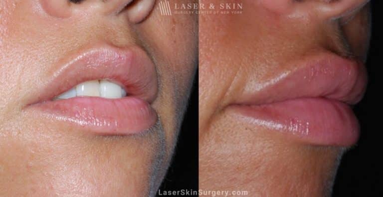 Filler Injections to add Volume to Lips