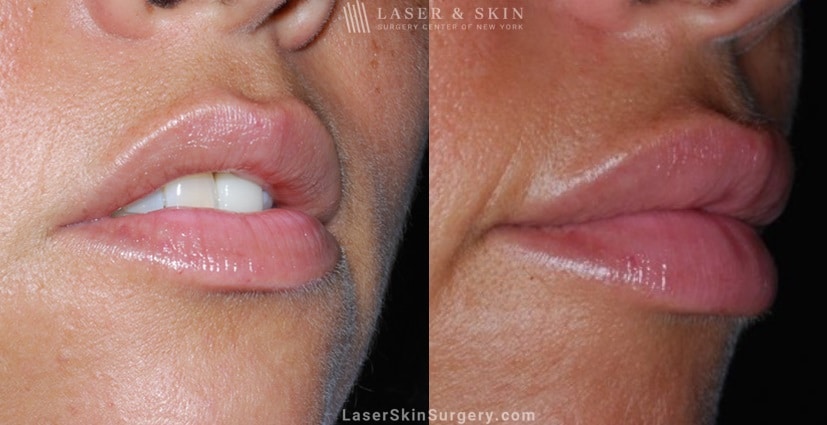 before and after image of filler injections in a skin of color woman