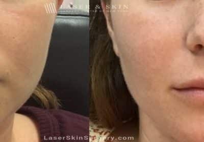 Filler Injections in the Lips to Add Volume