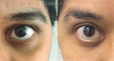 Filler Injections Under the Eye to Add Volume