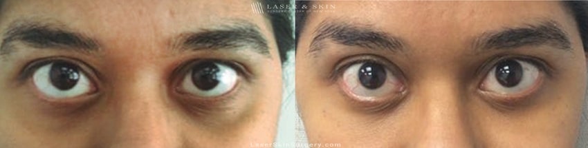 image of a before and after filler treatment under a woman's eyes