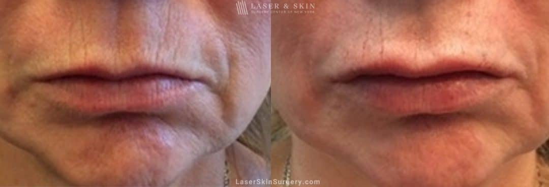 image of a before and after filler treatment to plump a woman's lips