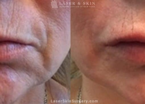 Filler Injections to Add Volume to Lips