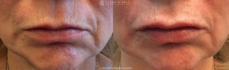 Filler Injections to Add Volume to Lips