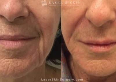 Filler Injections to Add Volume Around the Mouth Area