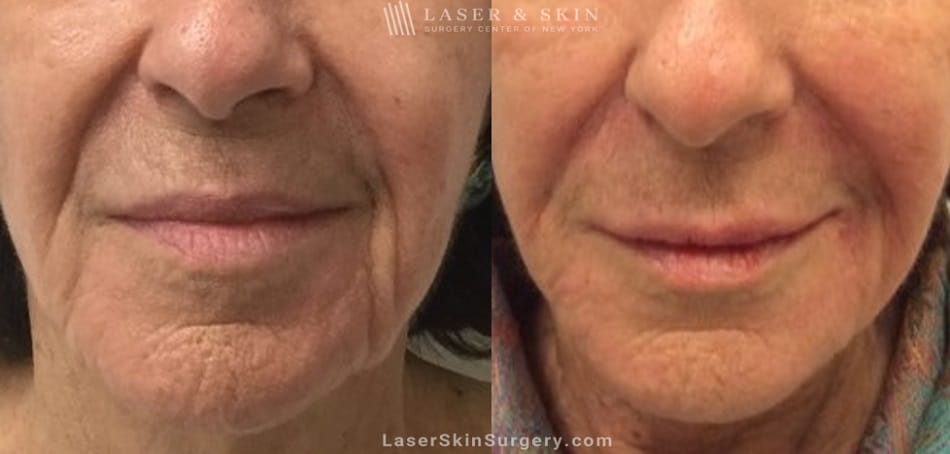 facial fillers results nyc