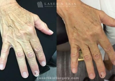 Filler Injections to Soften the Appearance of Aging Hands