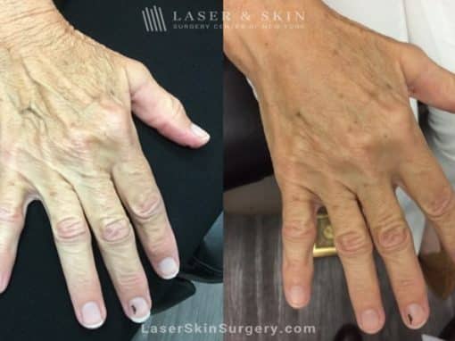 Filler Injections to Soften the Appearance of Aging Hands