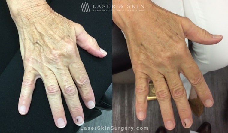 image of a before and after filler treatment to soften the appearance of aging hands