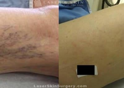 Sclerotherapy Injections for the Treatment of Spider Veins