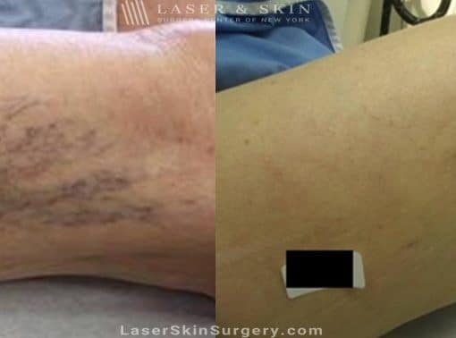 Sclerotherapy Injections for the Treatment of Spider Veins