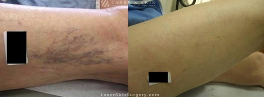 before and after image of a Sclerotherapy injections for the treatment of spider veins on the legs