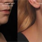 We are now offering Kybella for the improvement in the appearance of a moderate to severe “double chin”