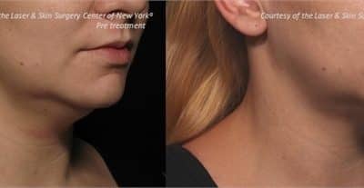 We are now offering Kybella for the improvement in the appearance of a moderate to severe “double chin”