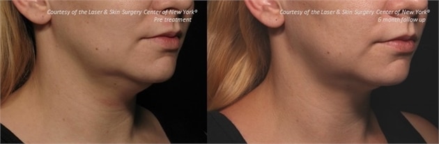 laser & skin surgery center of new york kybella double chin before and after new york ny