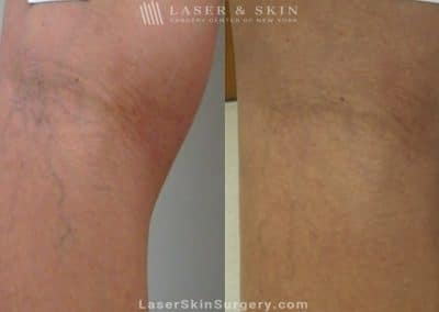 Laser Treatment for the Removal of Leg Veins