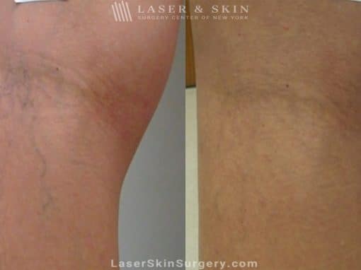 Laser Treatment for the Removal of Leg Veins