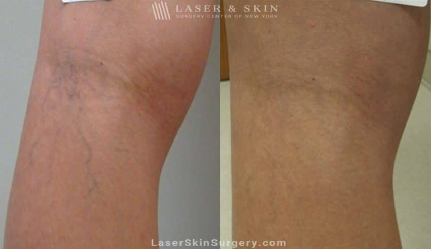 before and after image of a Laser Treatment for the removal of leg veins