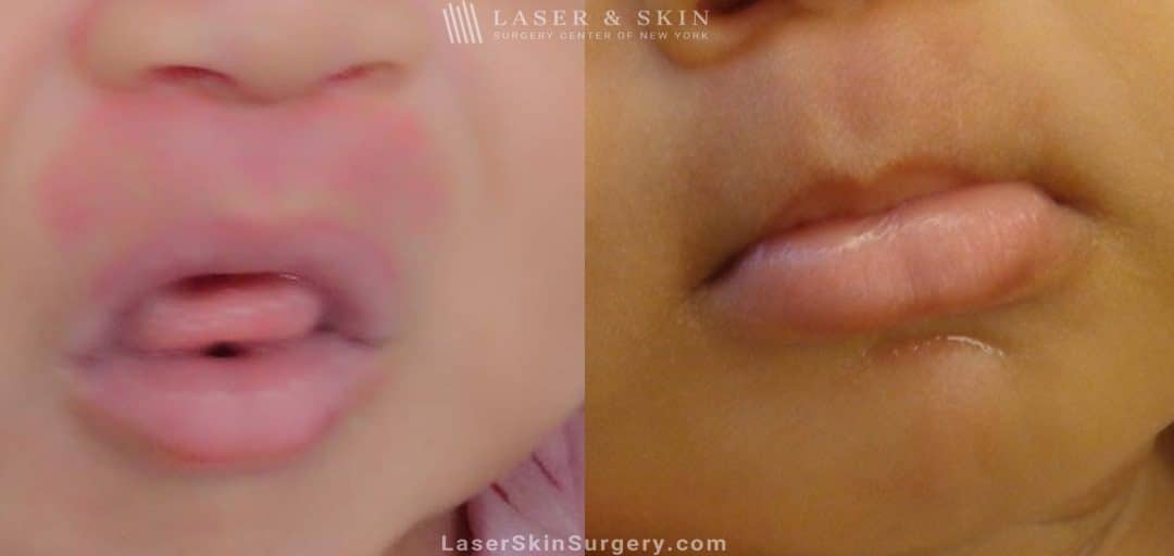 Before and after image of a Laser Treatment for Birthmark Removal on a baby's face