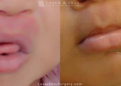 Laser Treatment for Birthmark Removal