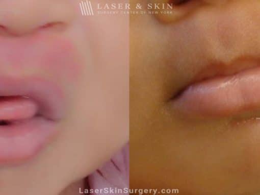 Laser Treatment for Birthmark Removal