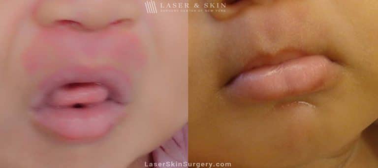 Laser Treatment for Birthmark Removal