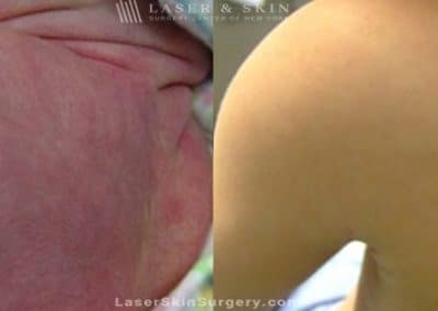 Laser Treatment For Birthmark Removal