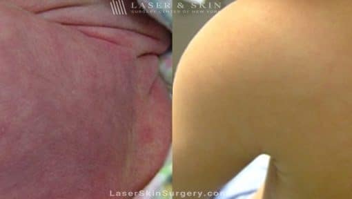 Laser Treatment For Birthmark Removal