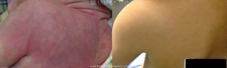 Laser Treatment For Birthmark Removal