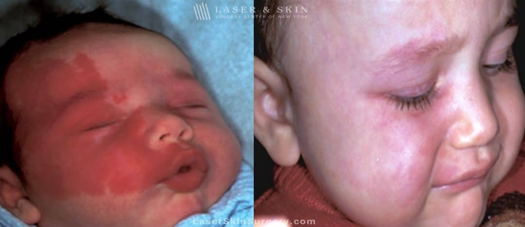 before and after image of a laser treatment for port wine stain removal on a baby