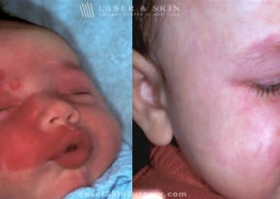 Port Wine Birthmark Removal