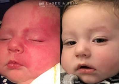 Laser Treatment for Birthmark Removal