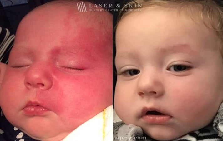 Laser Treatment for Birthmark Removal