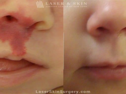 Laser treatment to remove port wine birthmark from infant’s face