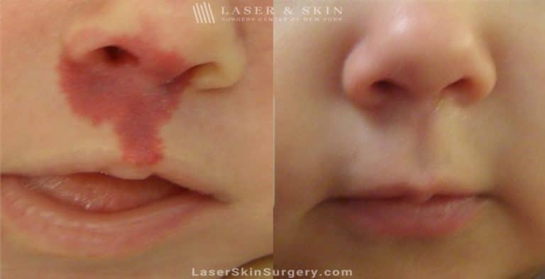 Laser treatment to remove port wine birthmark from infant’s face