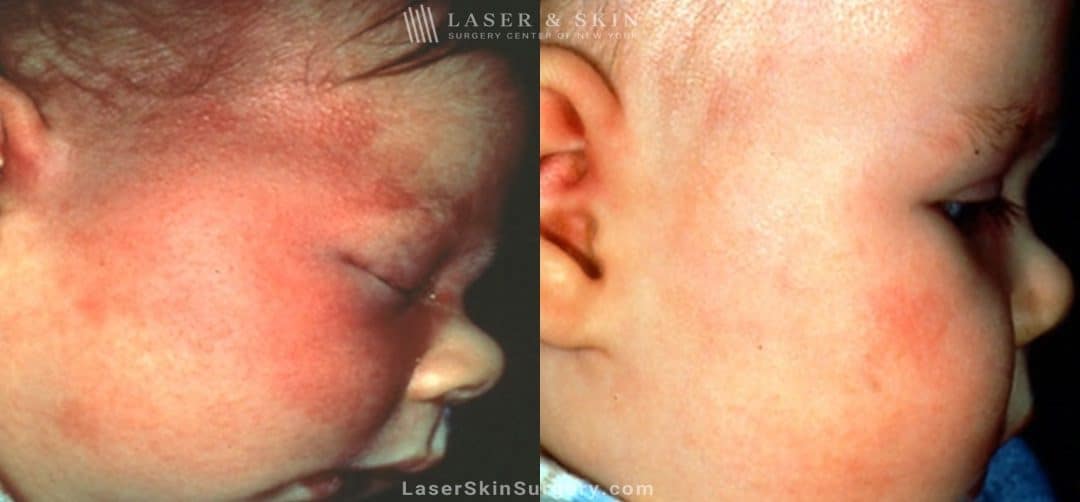 before and after image of a laser treatment for facial birthmark on a baby's face