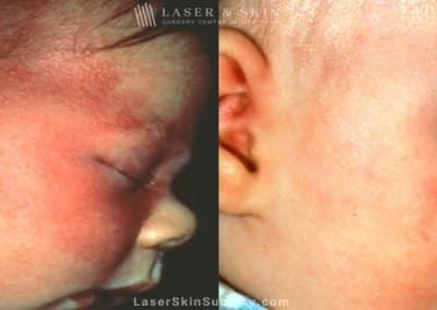 Laser Treatment for Birthmark Removal