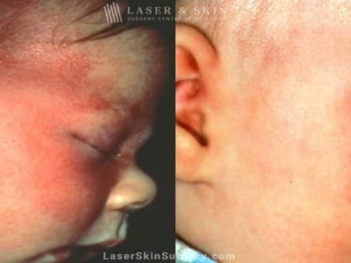 Laser Treatment for Birthmark Removal