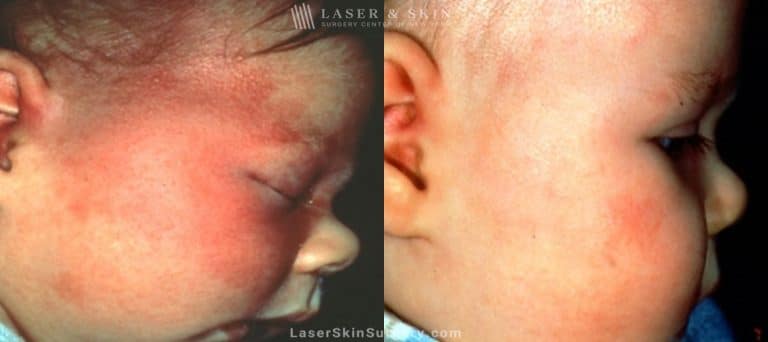 Laser Treatment for Birthmark Removal