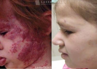 Laser treatment to remove large birthmark from child’s face