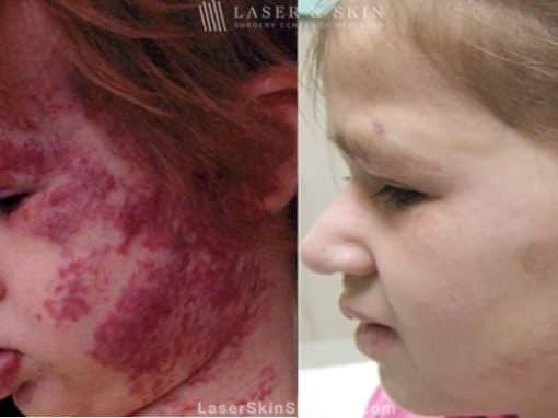 Laser treatment to remove large birthmark from child’s face