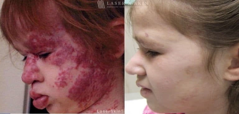 Laser treatment to remove large birthmark from child’s face